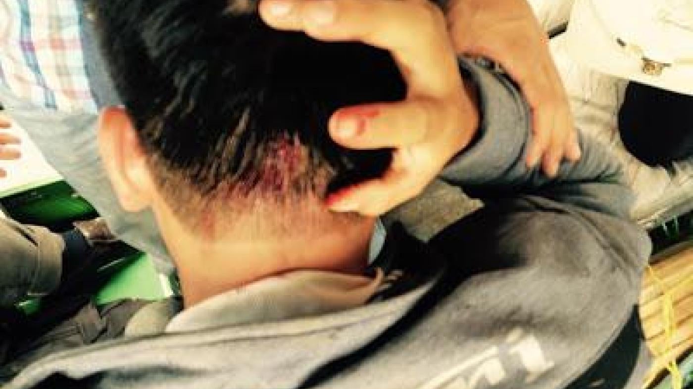 A man holding his head in pain with some blood visible, photo taken from behind