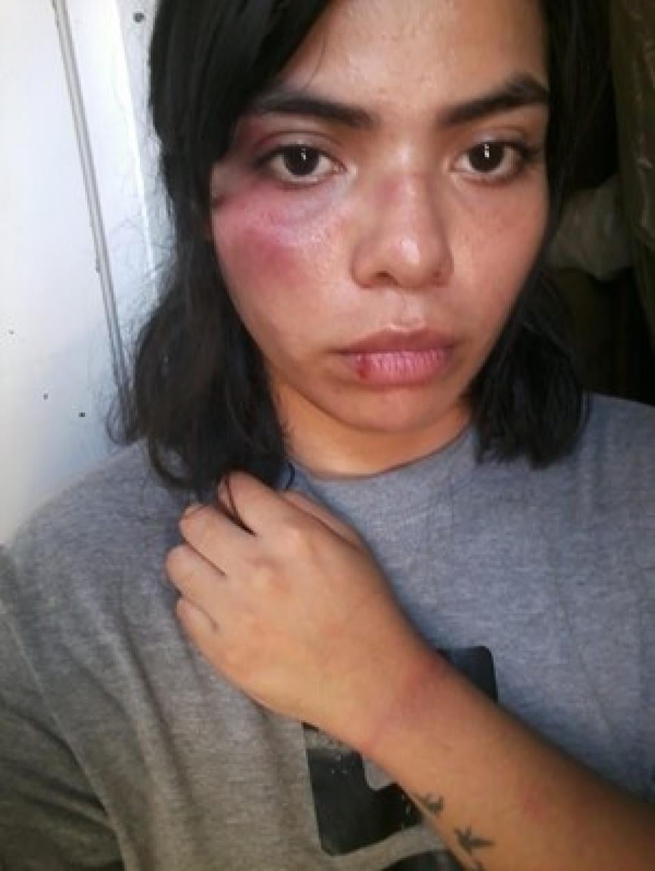 A woman takes a selfie showing bruising on her face and hand