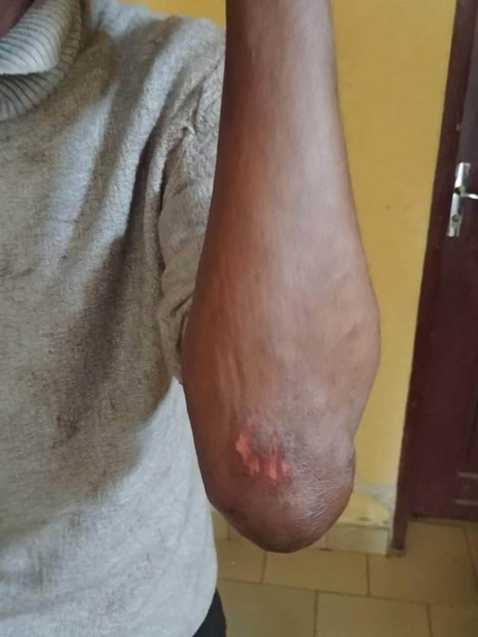 Une blessure subie par un enseignant de 32 ans qui a été violemment agressé le 9 mars 2022 par une bande l’accusant d’homosexualité à Buea, dans la région du Sud-Ouest au Cameroun. 
