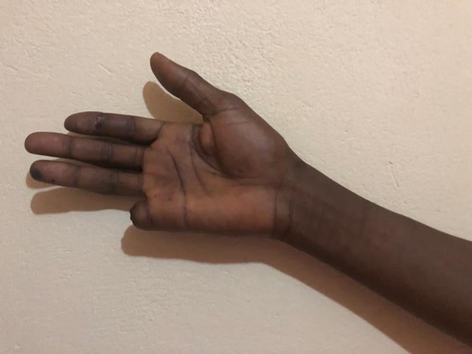 The right hand of Mahamat Nour Amadou, who said his finger was cut off by Russian-speaking forces in Bambari, Ouaka province, in January 2019. Nour spoke with international media about his case and told Human Rights Watch he feared for his life for speaking out. He was later killed, in September 2019, under unclear circumstances. 