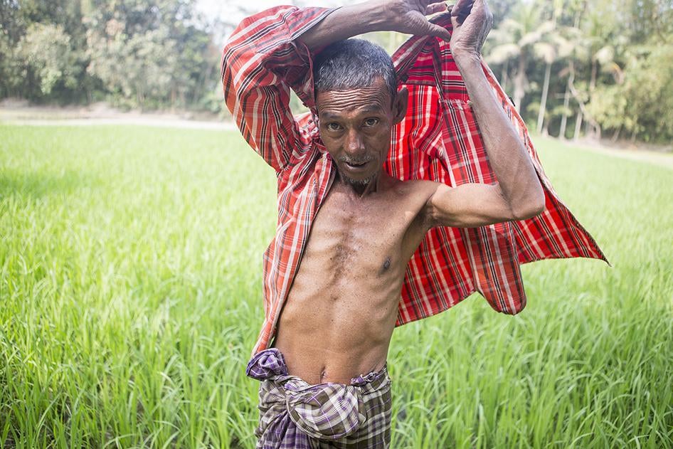 Dhudhu Miya, 50, has been suffering from arsenic-related health conditions for 10 years because of arsenic exposure. Iruain (Laksam Upazila in Comilla District). March 5, 2016. 